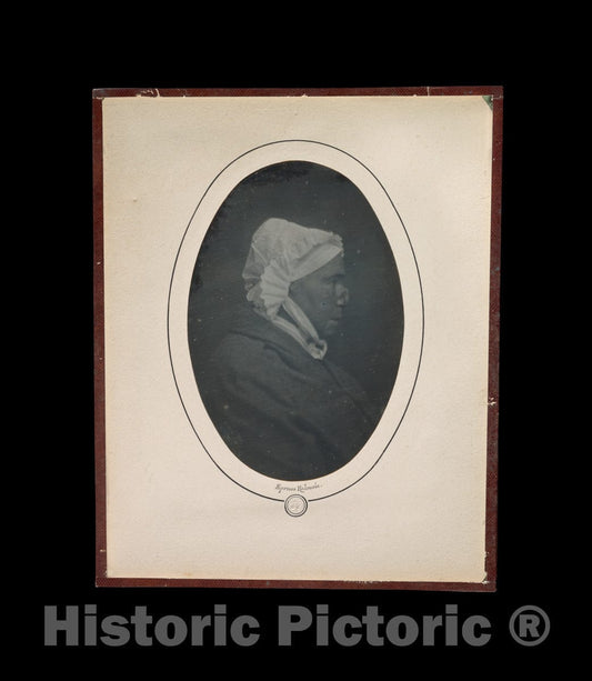 Photo Print : Louis-Auguste Bisson - Profile of a Woman with Necrosis of The Nose : Vintage Wall Art